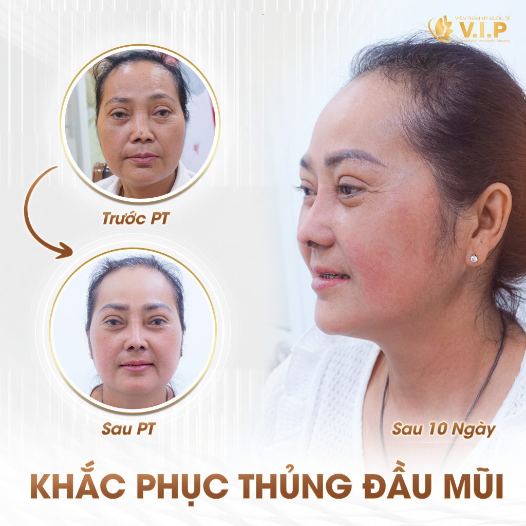 khắc phục triệt để tình trạng mũi hỏng