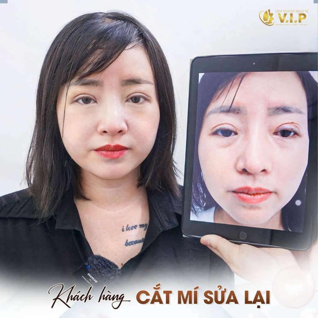 sửa lại mí hỏng hiệu quả tại thẩm mỹ viện VIP quận 1