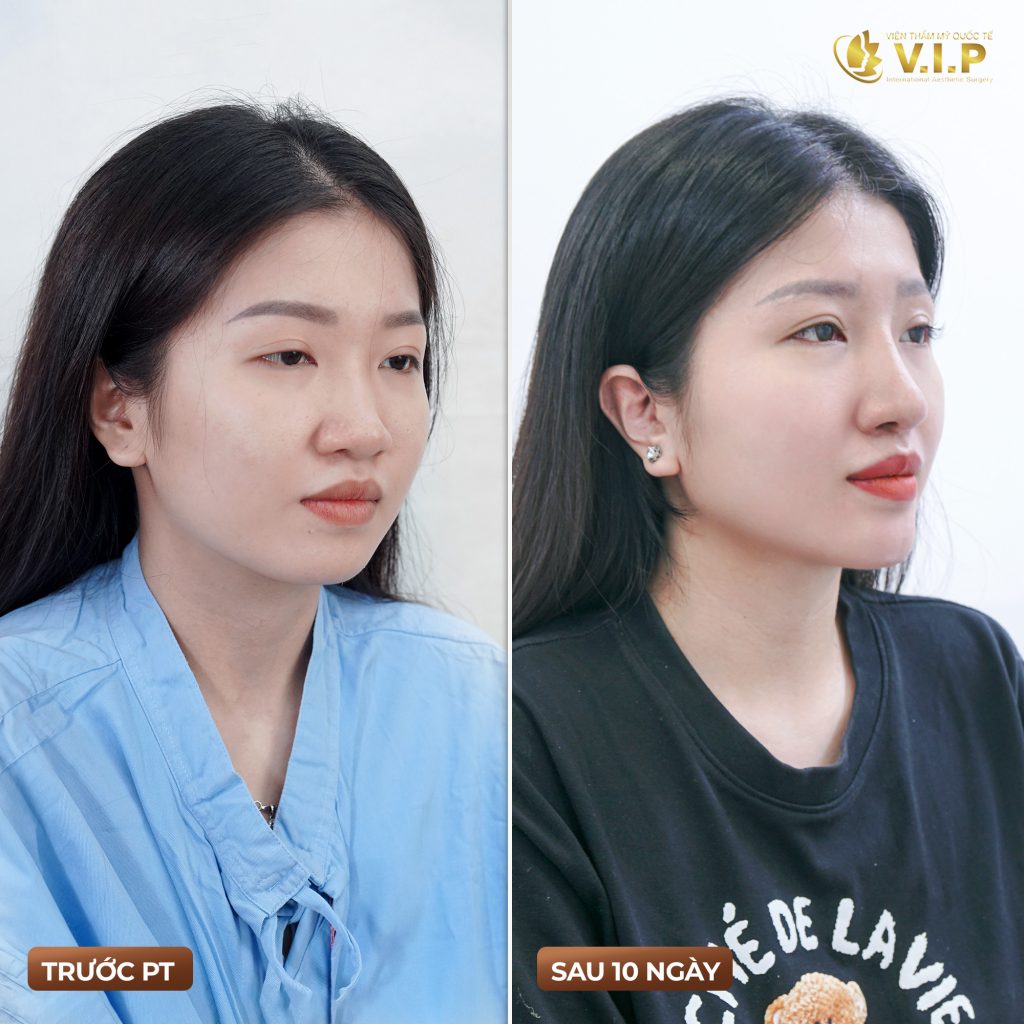 khách hàng xinh đẹp hơn sau khi nâng mũi hàn quốc
