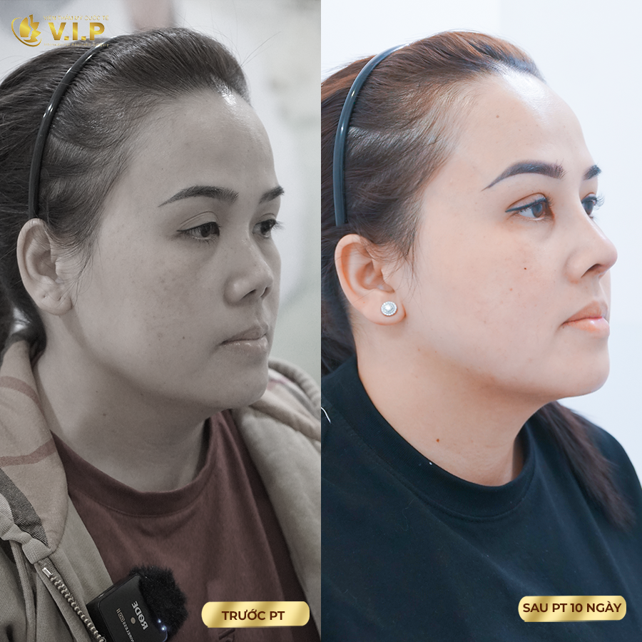 Mũi sửa lại đẹp an toàn tại V.I.P