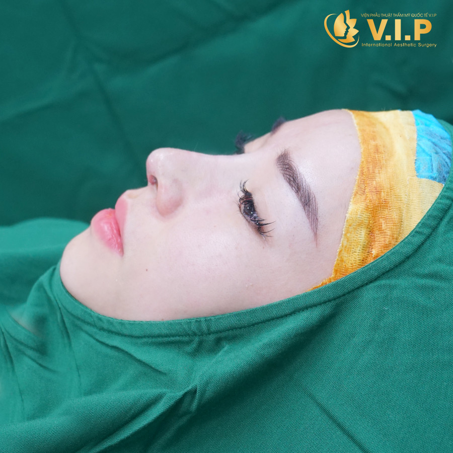 nâng mũi hàn quốc tại VIP đẹp ngay sau 45 phút
