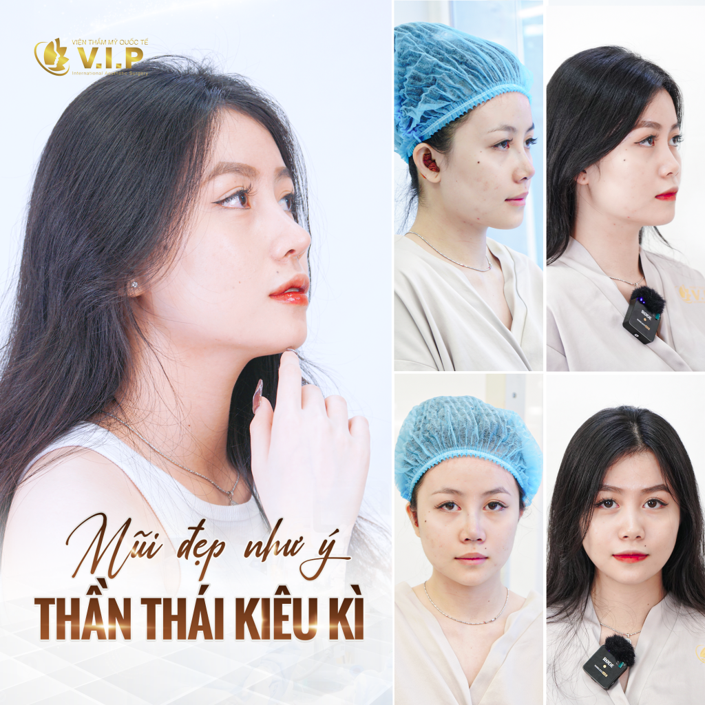 nâng mũi giúp thăng hạng nhan sắc