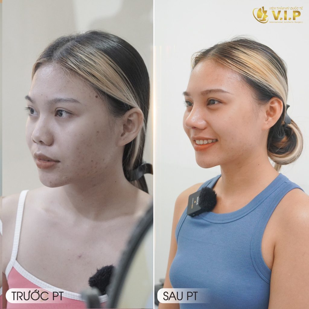 khách hàng nâng cấp nhan sắc nhờ nâng mũi
