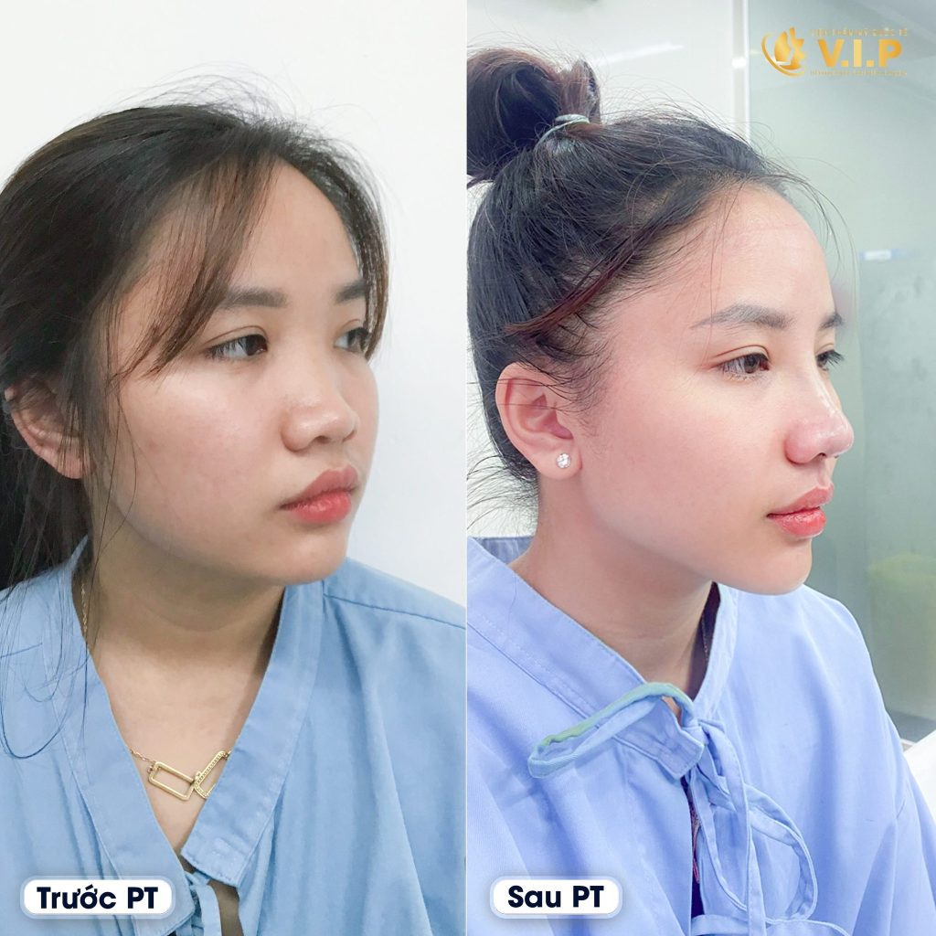 Mũi đẹp tự nhiên khi chọn V.I.P