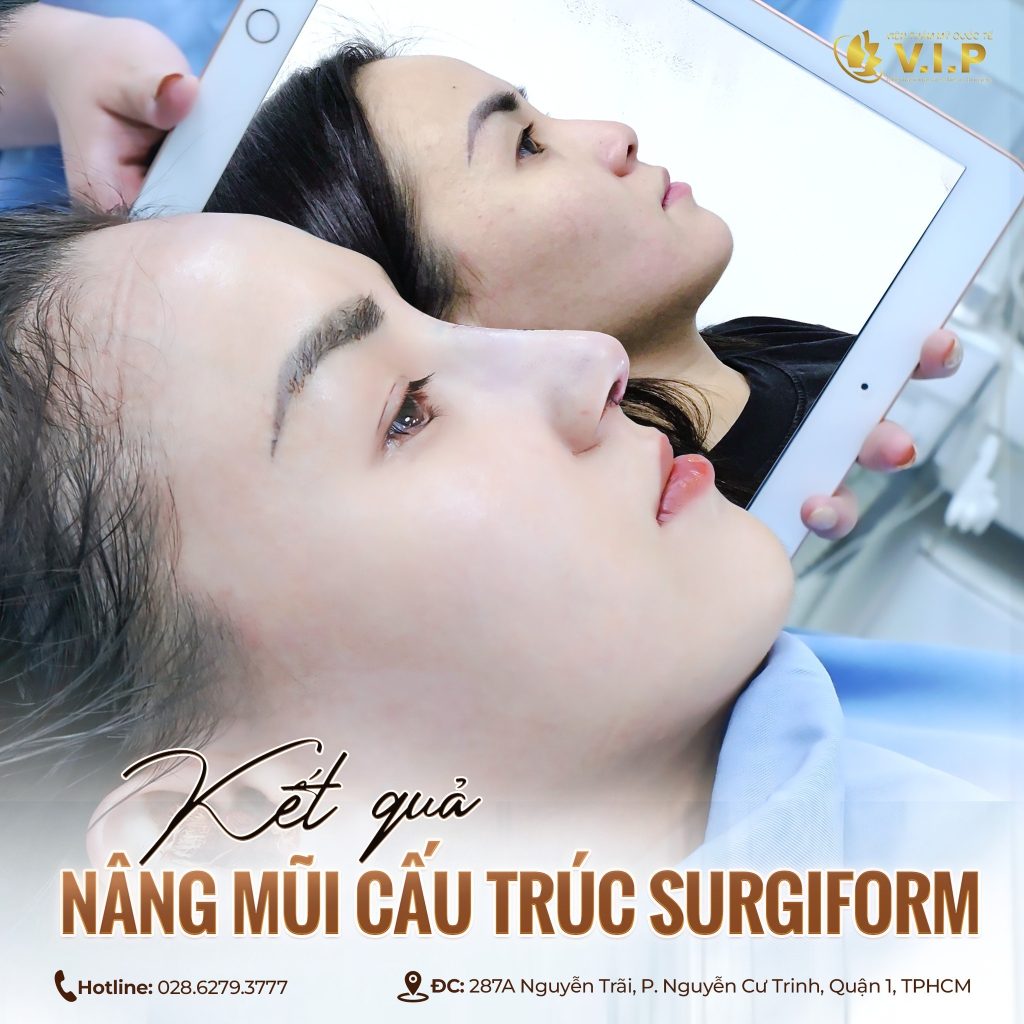 Nâng mũi cấu trúc an toàn và đẹp tự nhiên