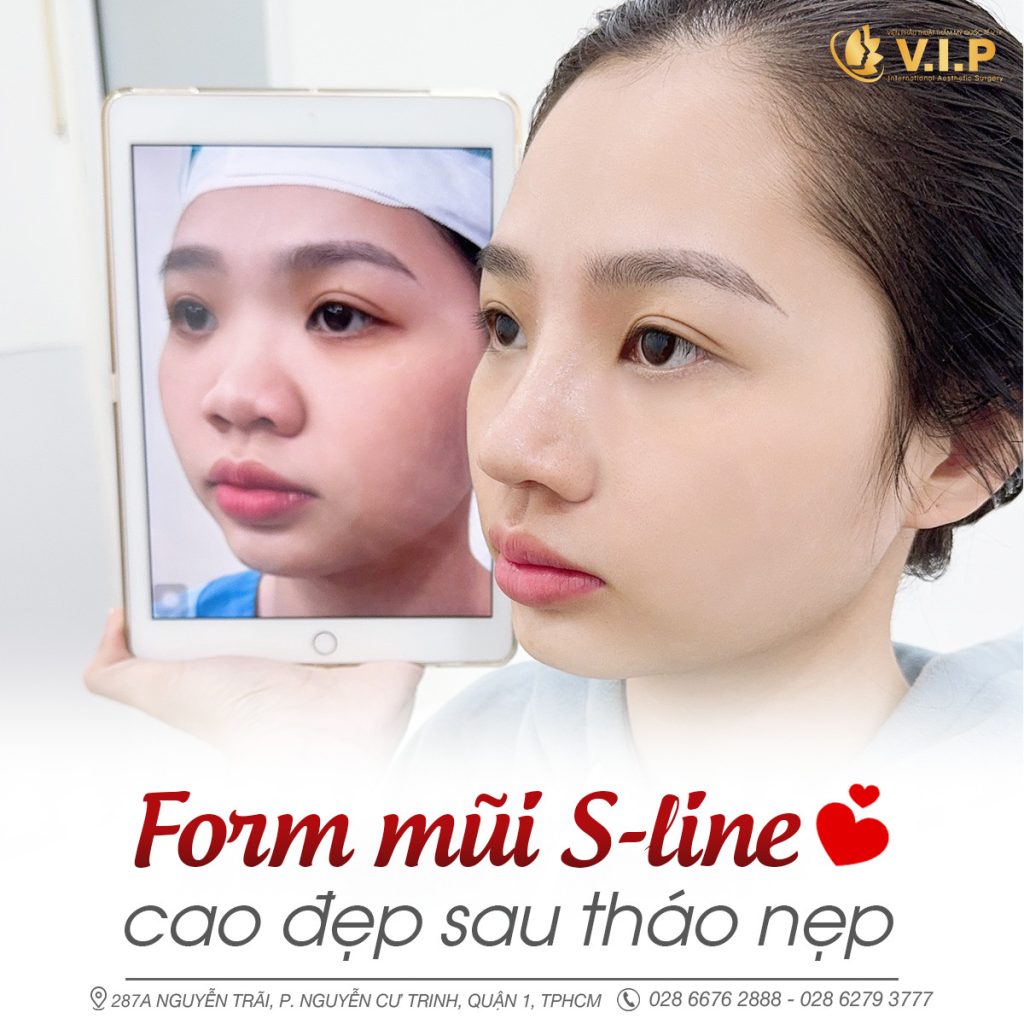 mũi bán cấu trúc cao đẹp ngay sau khi tháo nẹp