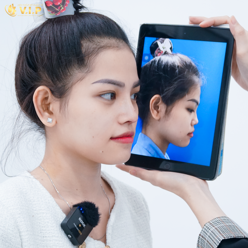 review nâng mũi đẹp an toàn tại thẩm mỹ viện V.I.P