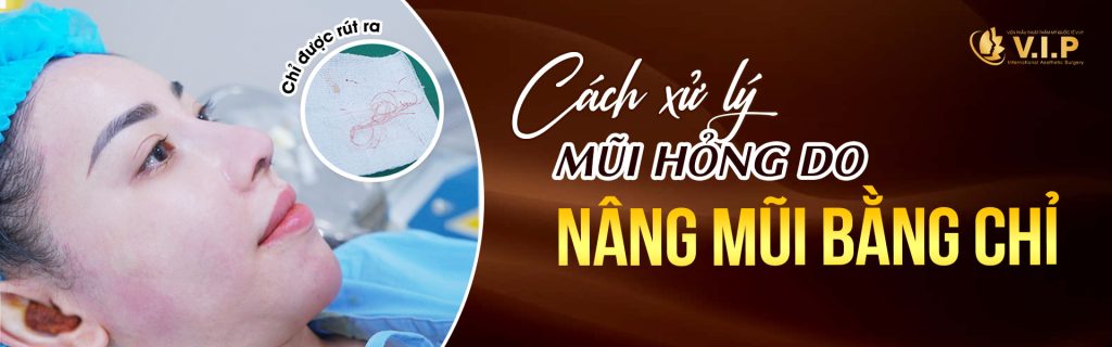 Cách xử lý mũihỏng do nâng mũi chỉ