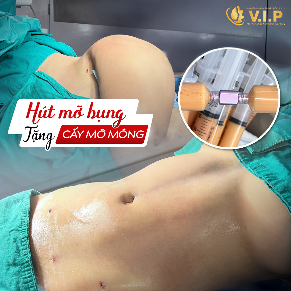 hút mỡ bụng tặng ngay cấy mỡ mông