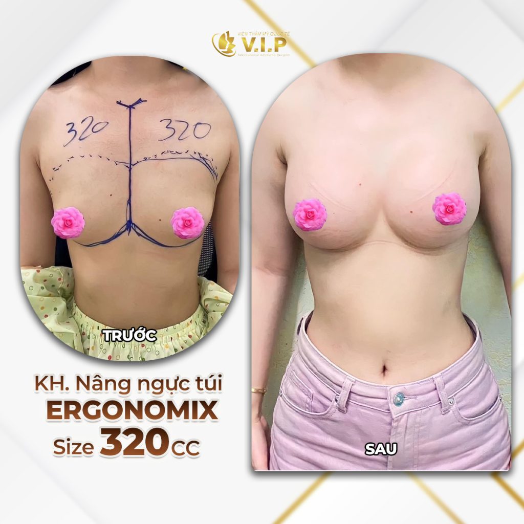 review kết quả nâng ngực tại thẩm mỹ viện VIP