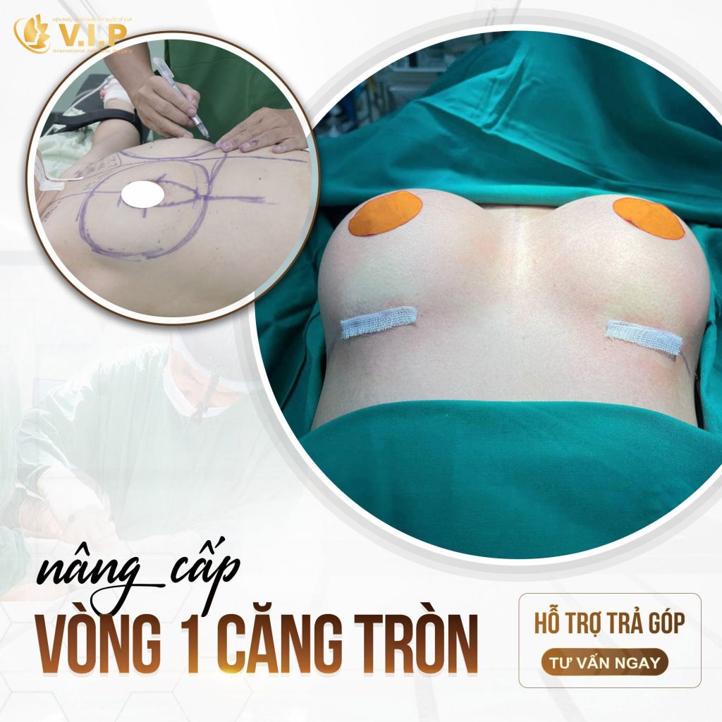vòng 1 căng tròn sau khi cấy mỡ ngực