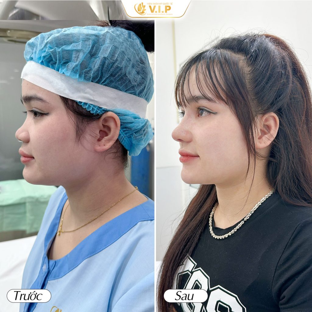 nâng mũi bán cấu trúc kết hợp thu cánh mũi