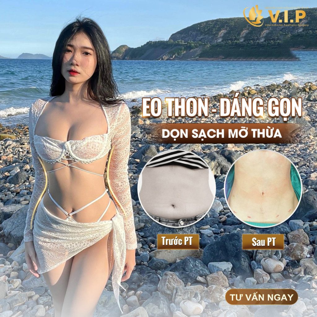 dáng đẹp, eo thon sau khi hút mỡ bụng