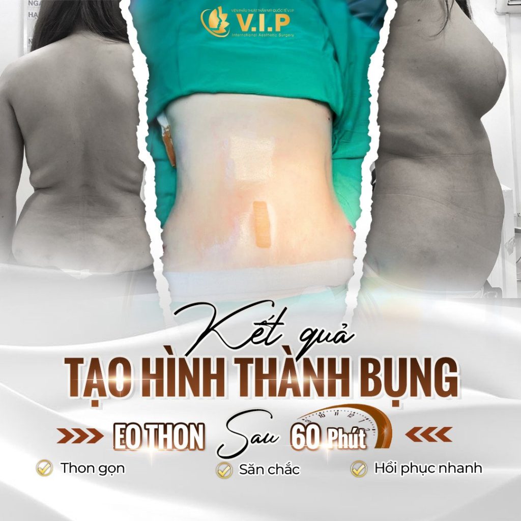 review kết quả hút mỡ tạo hình thành bụng tại thẩm mỹ viện V.I.P