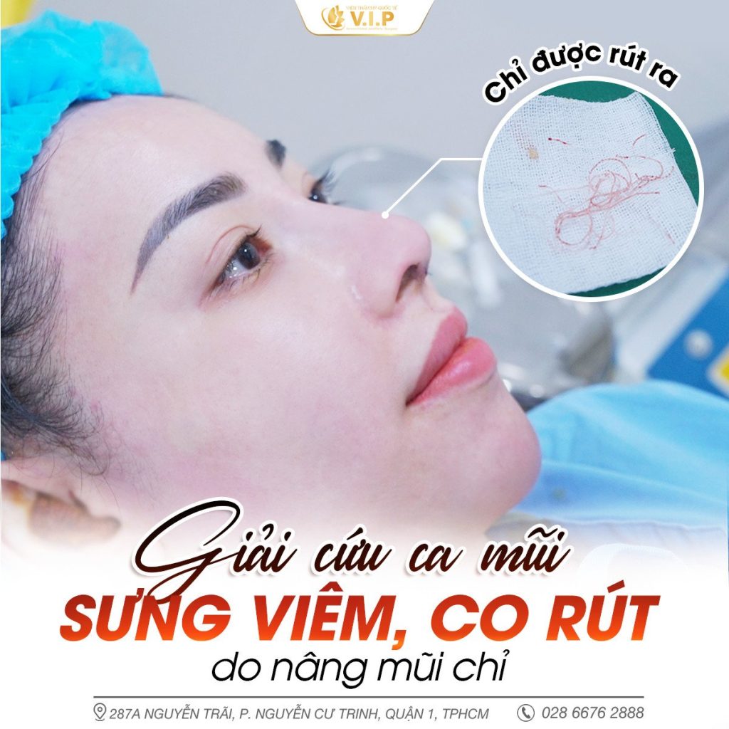V.I.P sửa lại mũi đẹp an toàn