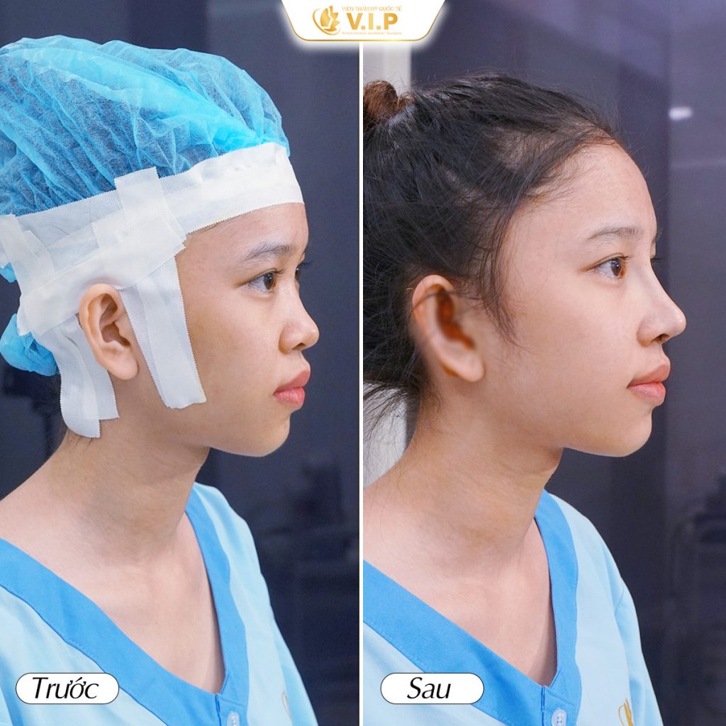 kết quả sau khi nâng mũi tại thẩm mỹ viện VIP