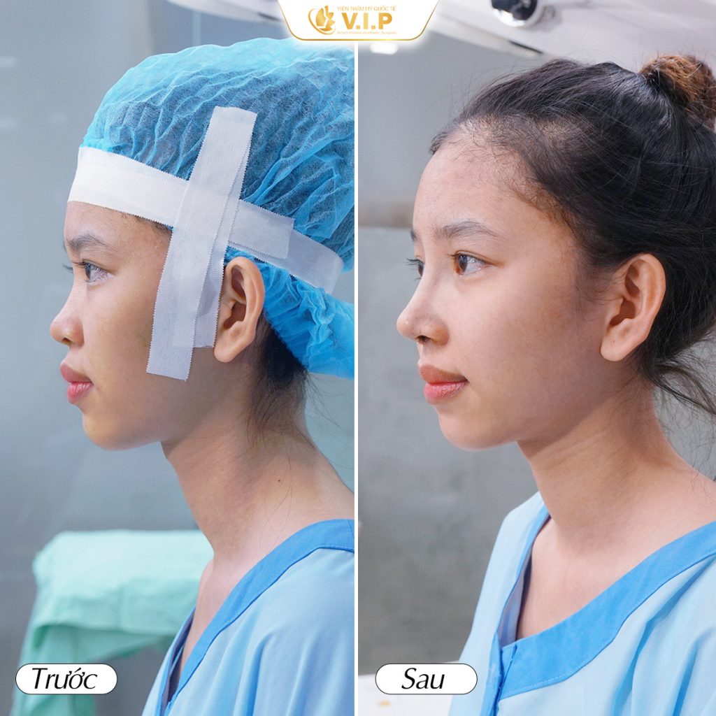 Mũi đẹp ngay sau 45 phút