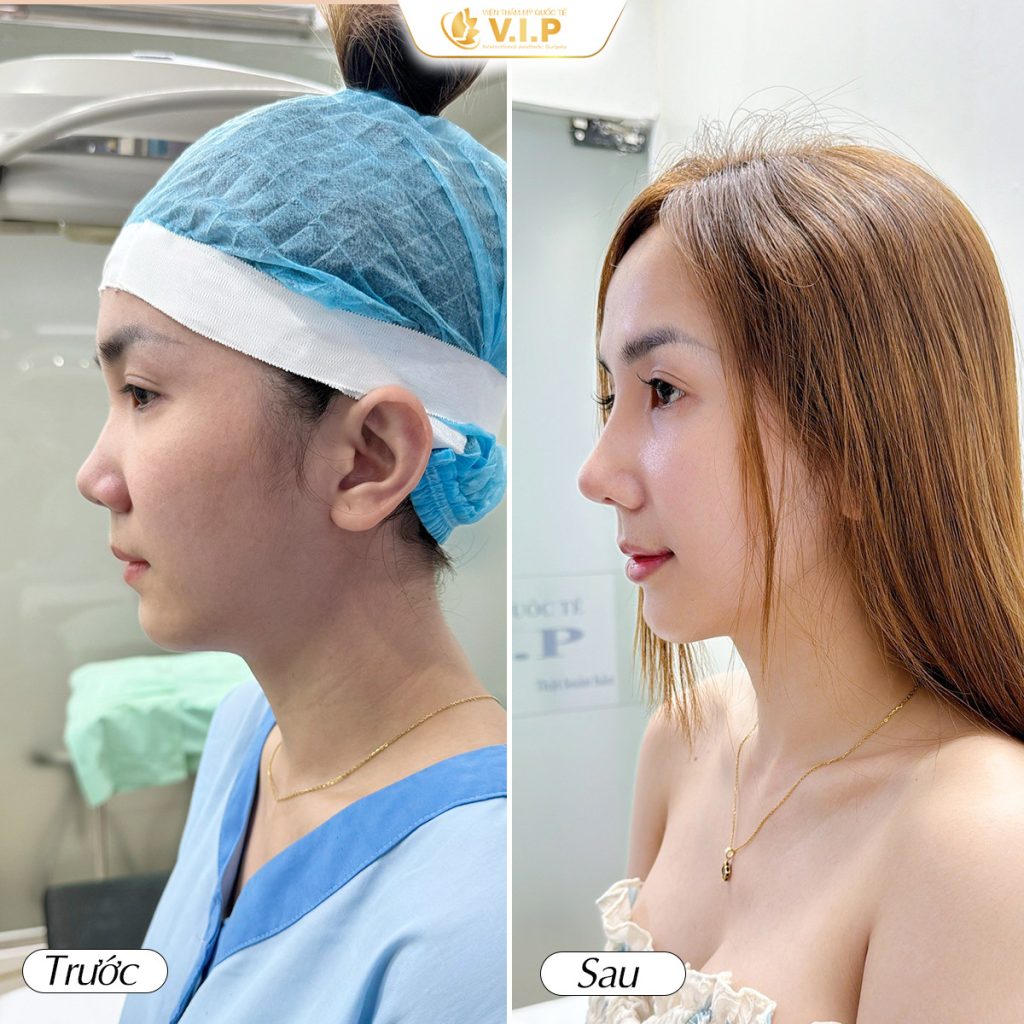 mũi đẹp tự nhiên của thẩm mỹ viện VIP quận 1