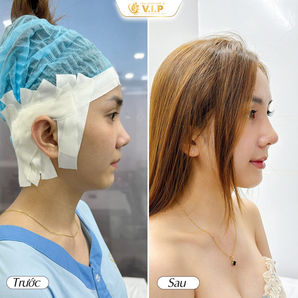 review thẩm mỹ viện V.I.P nâng mũi