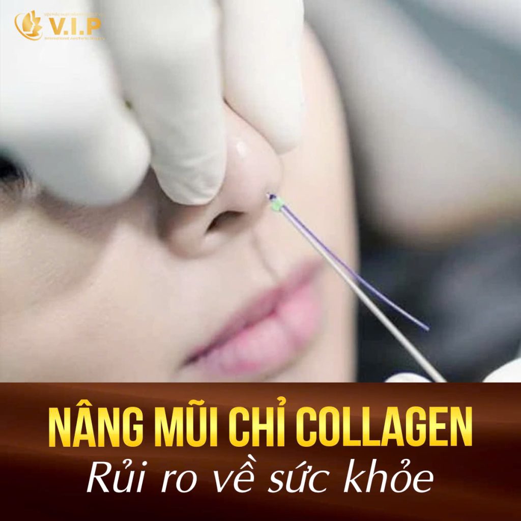 Nâng mũi chỉ tiềm ẩn nhiều rủi ro ảnh hưởng đến sức khỏe