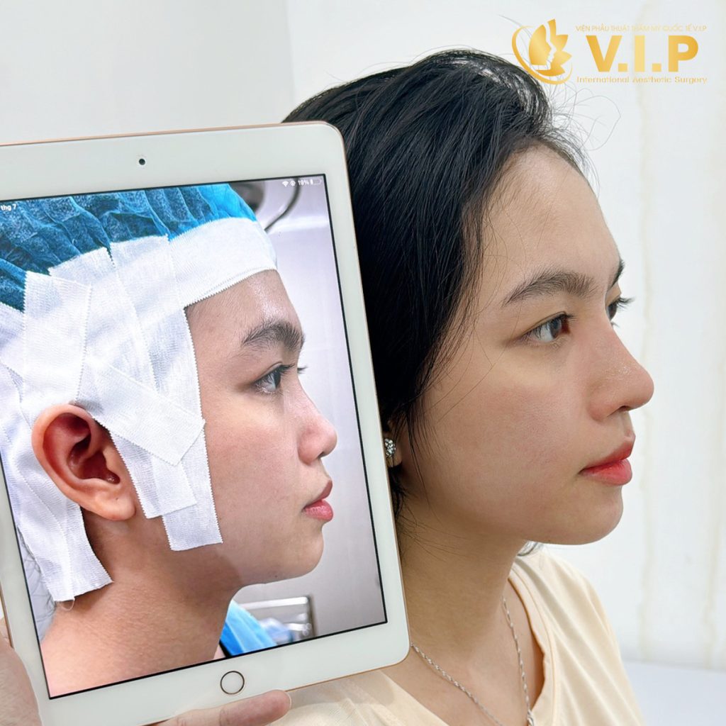 Mũi đẹp ngay sau khi cắt chỉ