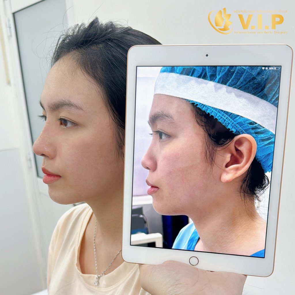 Mũi hồi phục chỉ sau 10 ngày