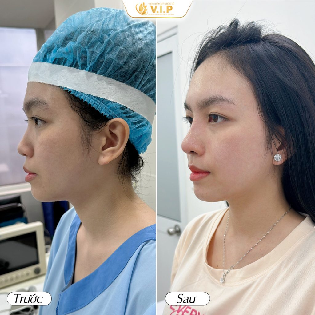 thẩm mỹ viện VIP quận 1 nâng mũi đẹp