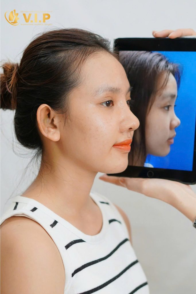 khách hàng nâng mũi đẹp tại V.I.P