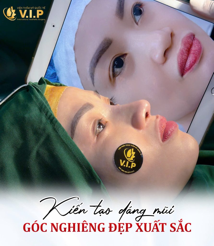 review kết quả sau khi nâng mũi tại V.I.P