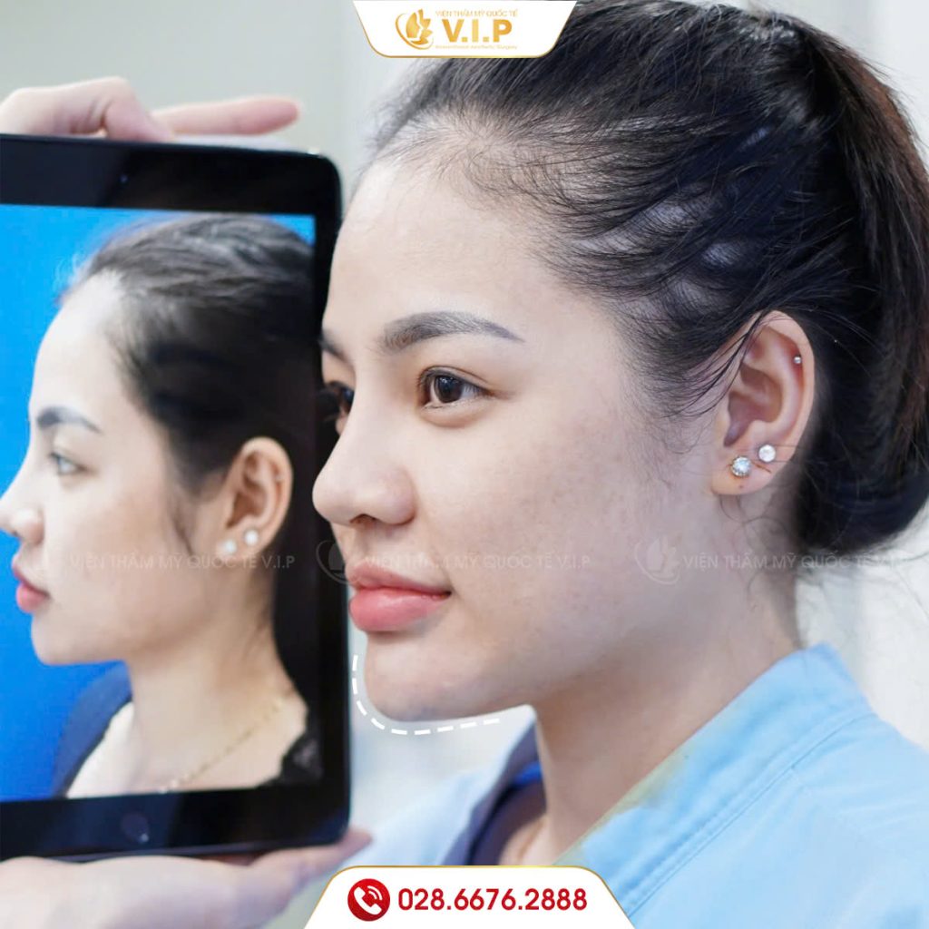 độn cằm vline tại thẩm mỹ viện VIP quận 1